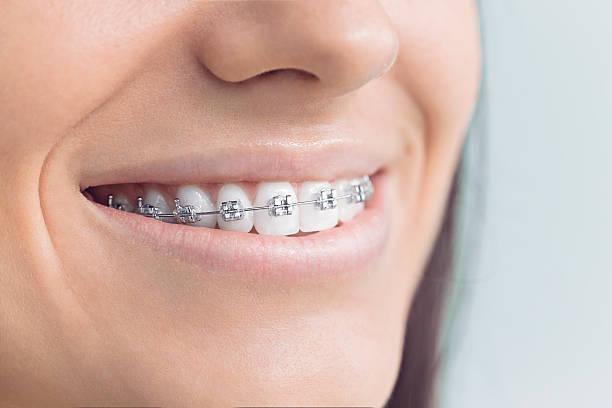 Best Traditional Braces  in Montclair, CA